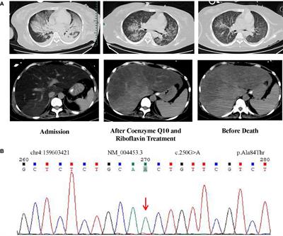 Case Report: Hemophagocytic Lymphocytosis in a Patient With Glutaric Aciduria Type IIC